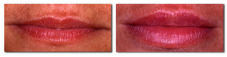 Fat Injection Pictures