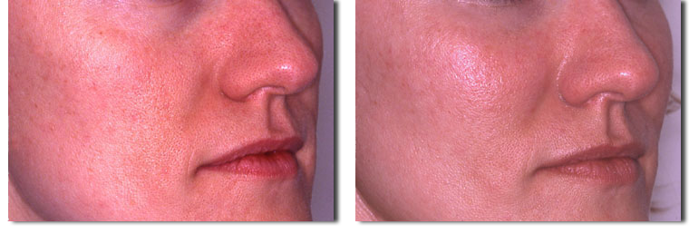 Fat Injection Pictures