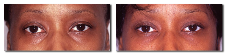 Fat Injection Pictures